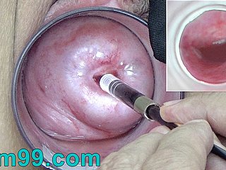 Wheezles cámara endoscopio japonés dentro del cuello uterino en chilled through vagina Cam